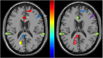 A Case of Psychogenic Myoclonus Responding to a Novel Transcranial Magnetic Stimulation Approach: Rationale, Feasibility, and Possible Neurophysiological Basis